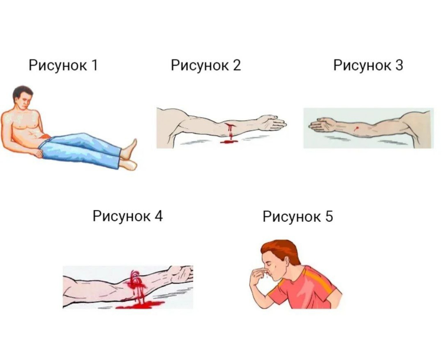 Изображение задачи: Какие кровотечения изображены на рисунках, что дел